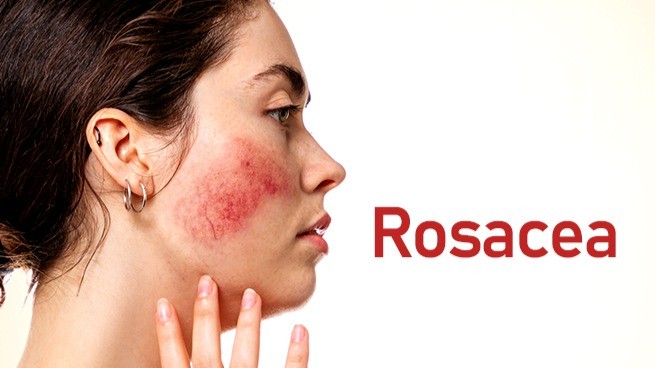 Shop Korean Skincare for Rosacea in Canada