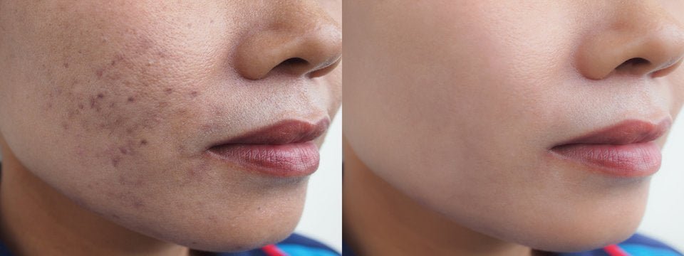 Best 10 Korean Skincare Products for Acne in Canada - Lakinza K-beauty Canada