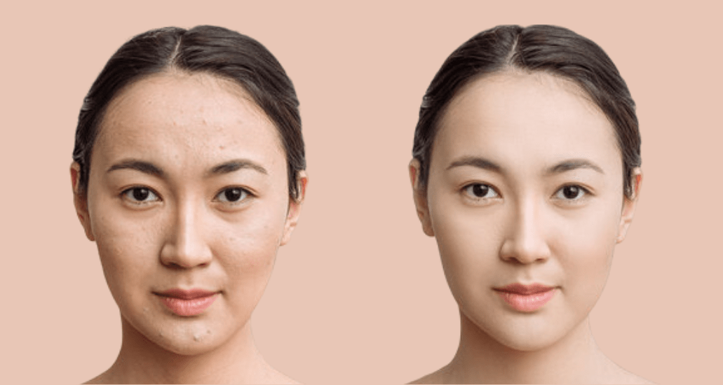 Best Korean Moisturizers for Acne in Canada - Lakinza K-beauty Canada