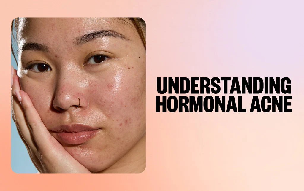 Best Skincare for Hormonal Acne in Canada - Lakinza K-beauty Canada