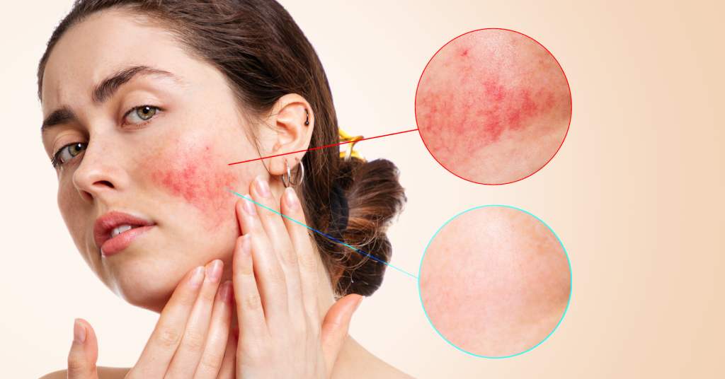 How to Fix Damaged Skin Barrier Using Korean Skincare in Canada - Lakinza K-beauty