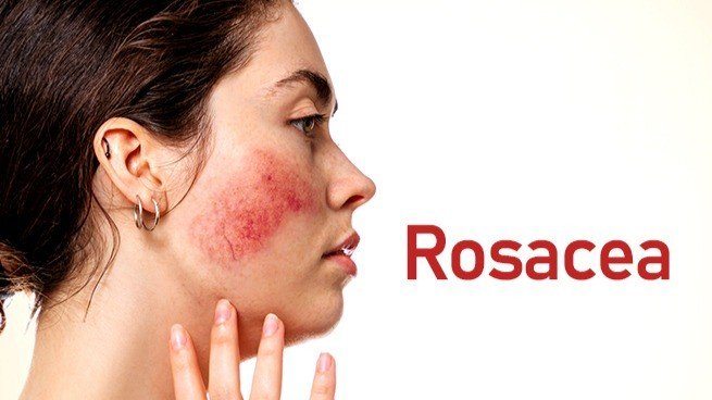 Korean Skincare for Rosacea in Canada - Lakinza K-beauty