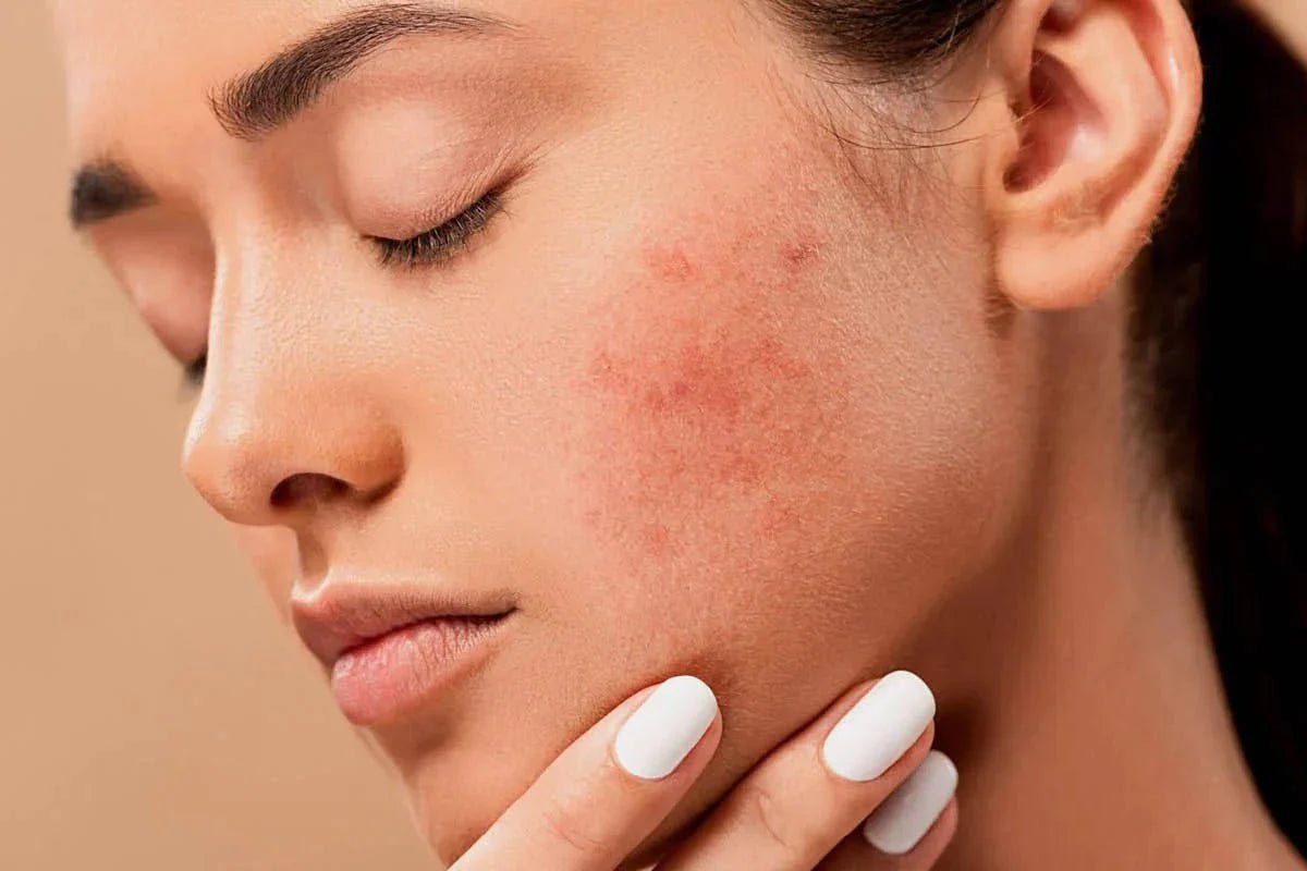 Korean Skincare for Rosacea-Prone Skin in Canada - Lakinza K-beauty