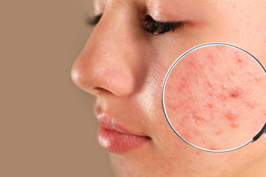The Power of Korean Skincare for Acne-Prone Skin - Lakinza K-beauty