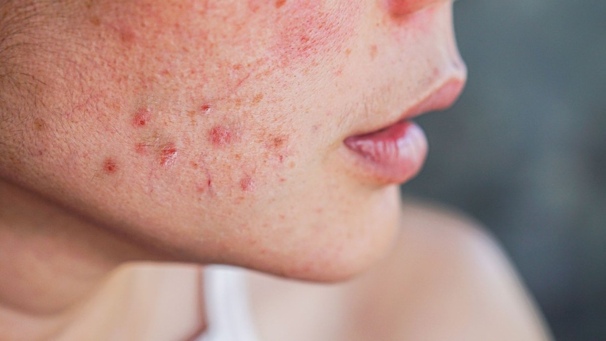 Understanding and Managing Hormonal Acne: An In-Depth Guide - Lakinza K-beauty