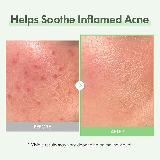 Shop Azelaic acid Korean Skincare - Lakinza K-beauty